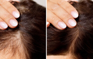 Hair Loss Treatment