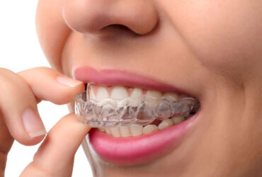 Invisible Braces & Invisalign