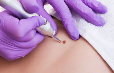 Mole & Wart Removal