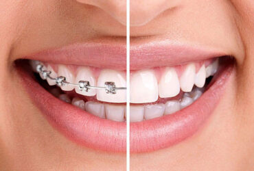 Orthodontics / Braces