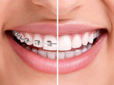Orthodontics / Braces