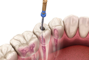 Root Canal Treatment Fillings / Restorations