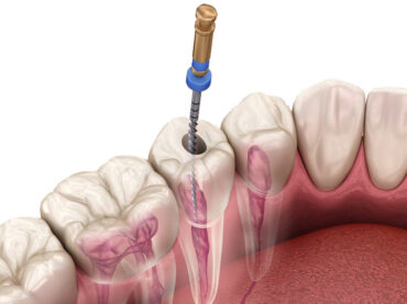 Root Canal Treatment Fillings / Restorations
