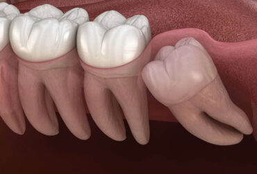 Teeth Extraction & Impaction