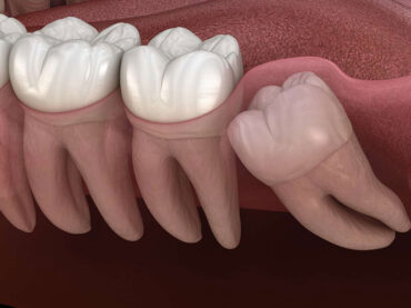 Teeth Extraction & Impaction